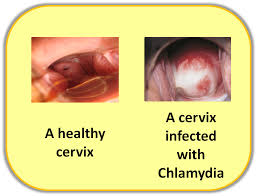 chlamydia